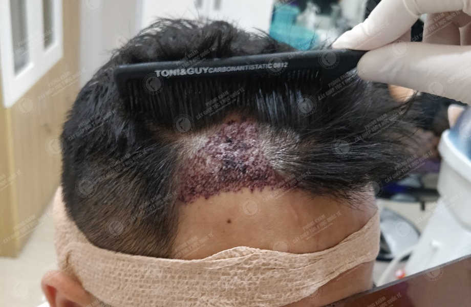 Vũ Hoàng Linh - Cấy tóc đường chữ M 5