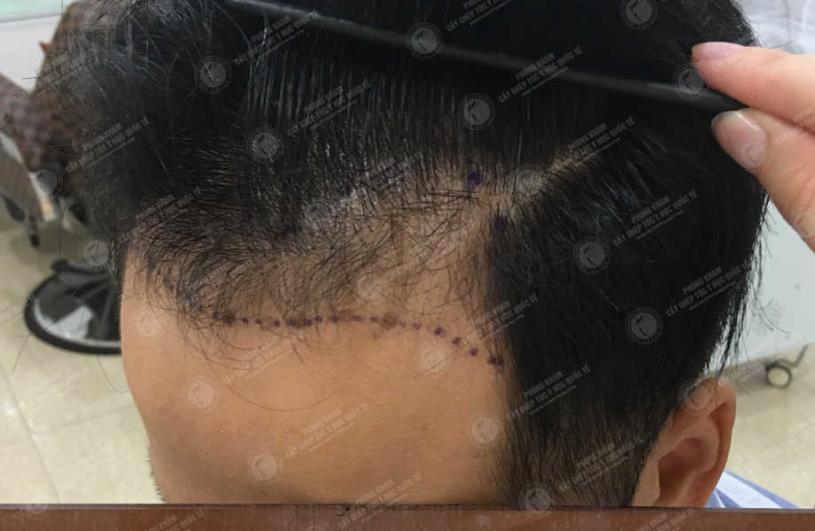Anh Hoàng Long - Cấy tóc đường chữ M 2