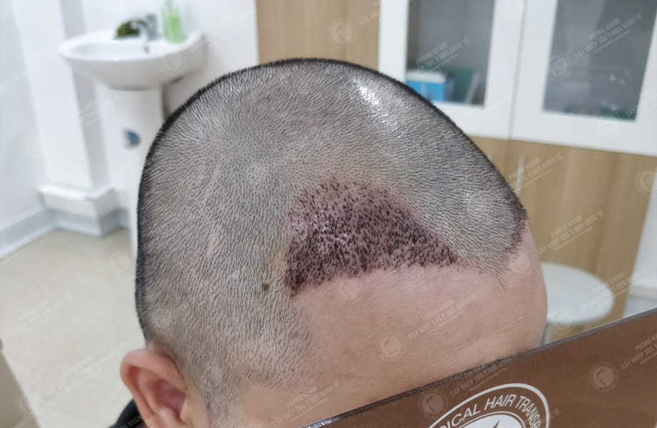 Trần Trung Kiên - Cấy tóc đường chữ M 4