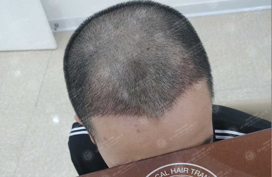 Trần Trung Kiên - Cấy tóc đường chữ M 5