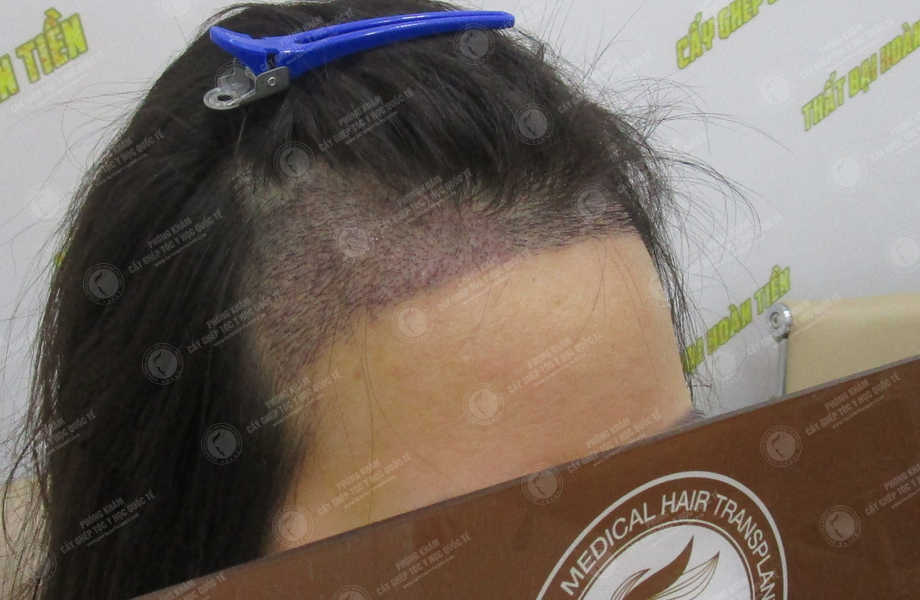 Lê Thị Huyền Trang - Cấy tóc tự thân 10