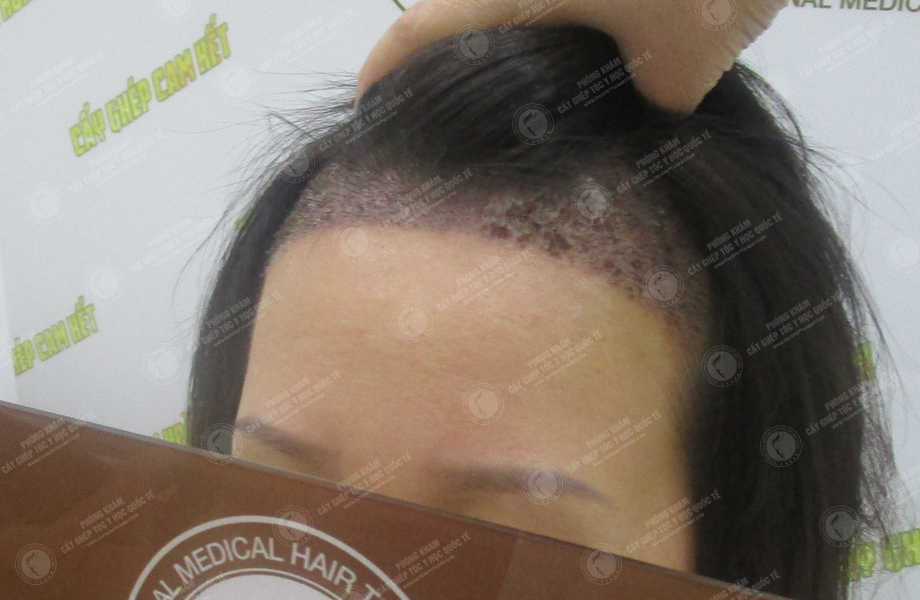 Lê Thị Huyền Trang - Cấy tóc tự thân 8