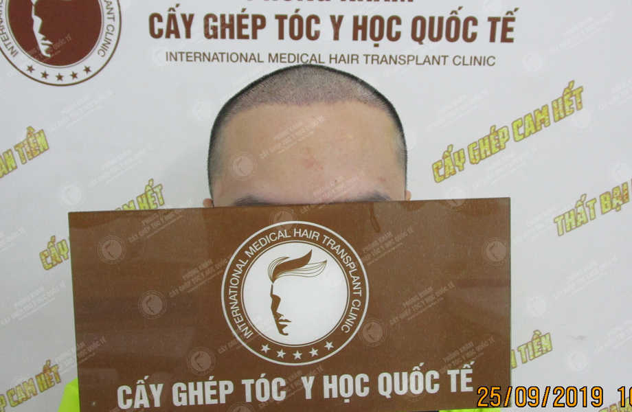 Lê Hồng Phong - Cấy tóc đường chữ M 6