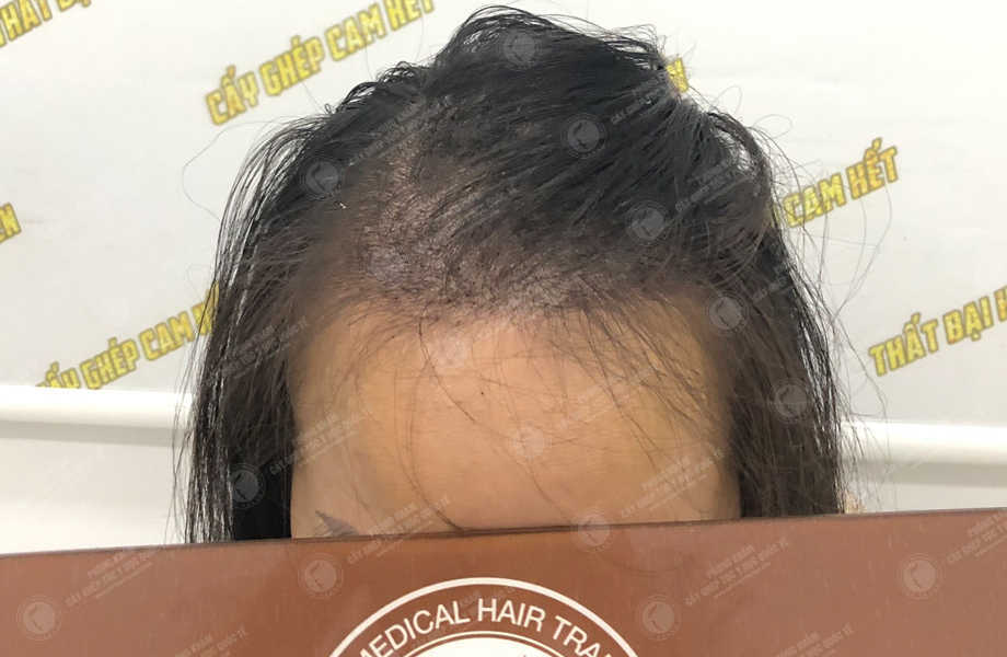 Phạm Minh Lý - Cấy tóc tự thân 6