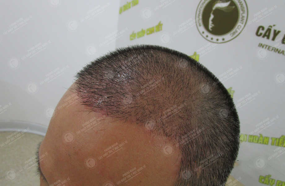 Hoàng Bảo Minh - Cấy tóc tự thân 9
