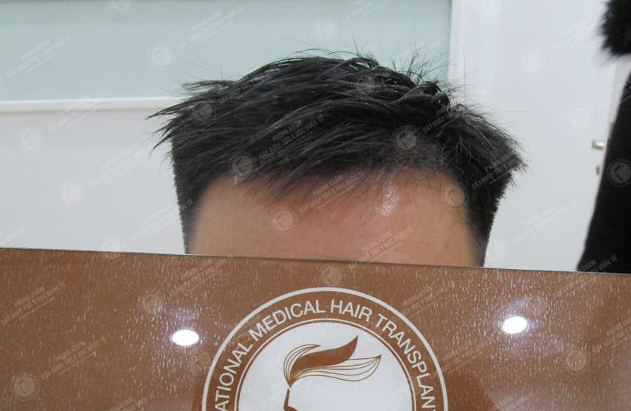 Tô Thanh Hải - Cấy tóc tự thân 10
