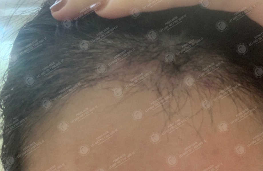 Phạm T.Mỹ Dung - Cấy tóc tự thân 12