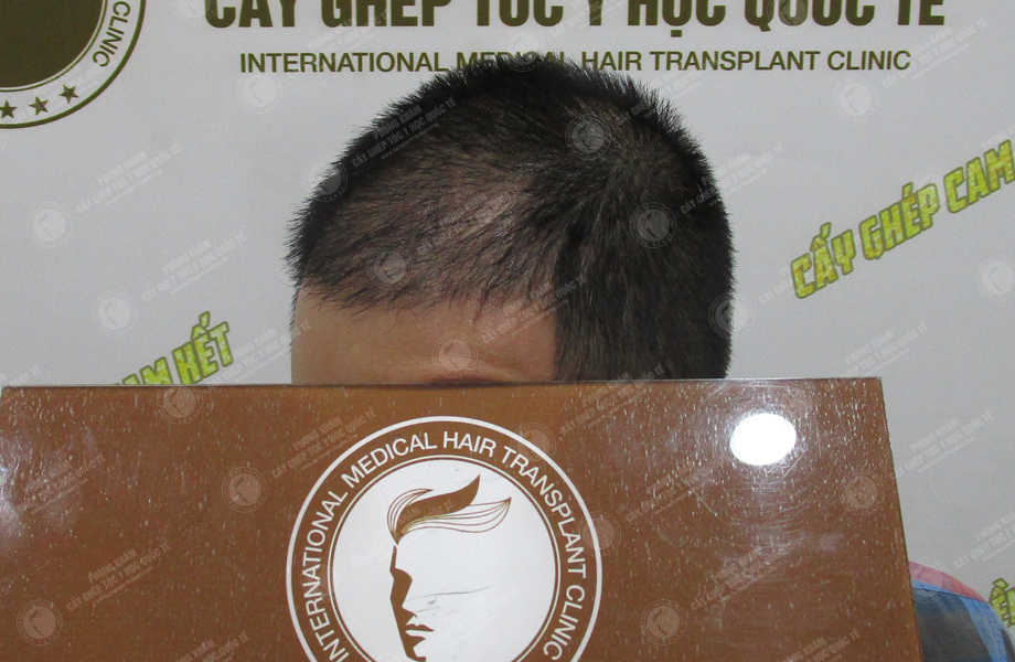 Phạm Hồng Quyết - Cấy tóc trên sẹo 16