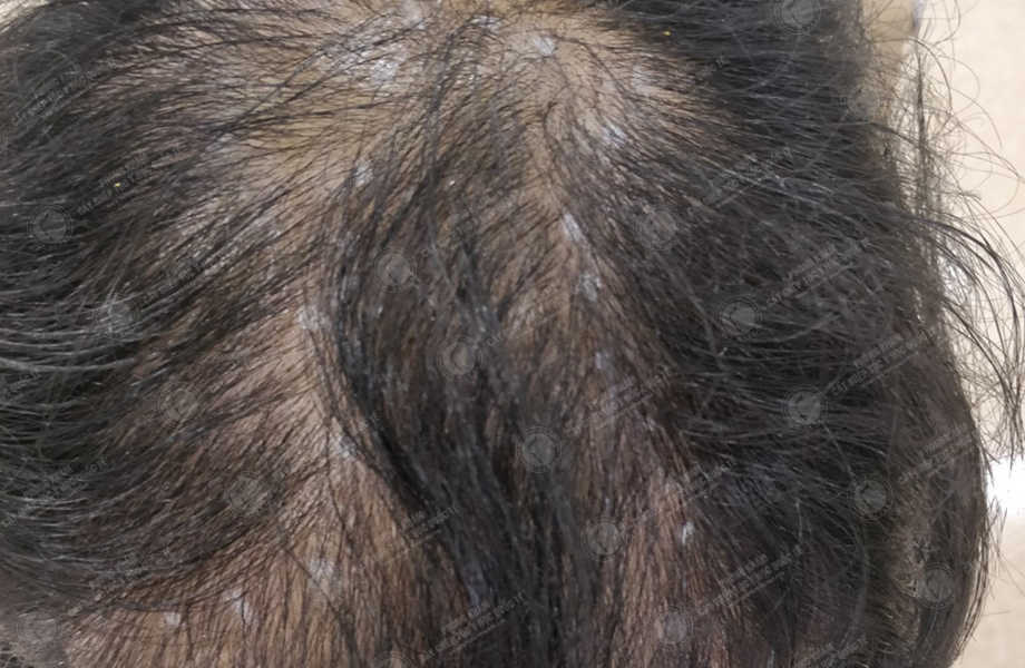 Phạm Thế Hùng - Cấy tóc tự thân 3