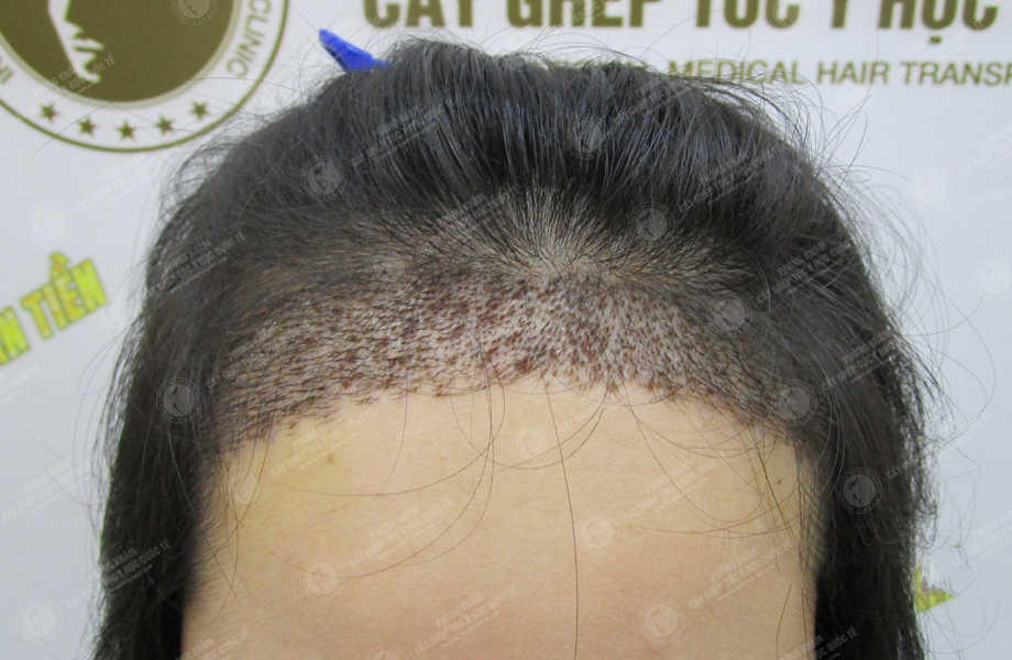 Ngô Thúy Hằng - Điều chỉnh đường chân tóc 7