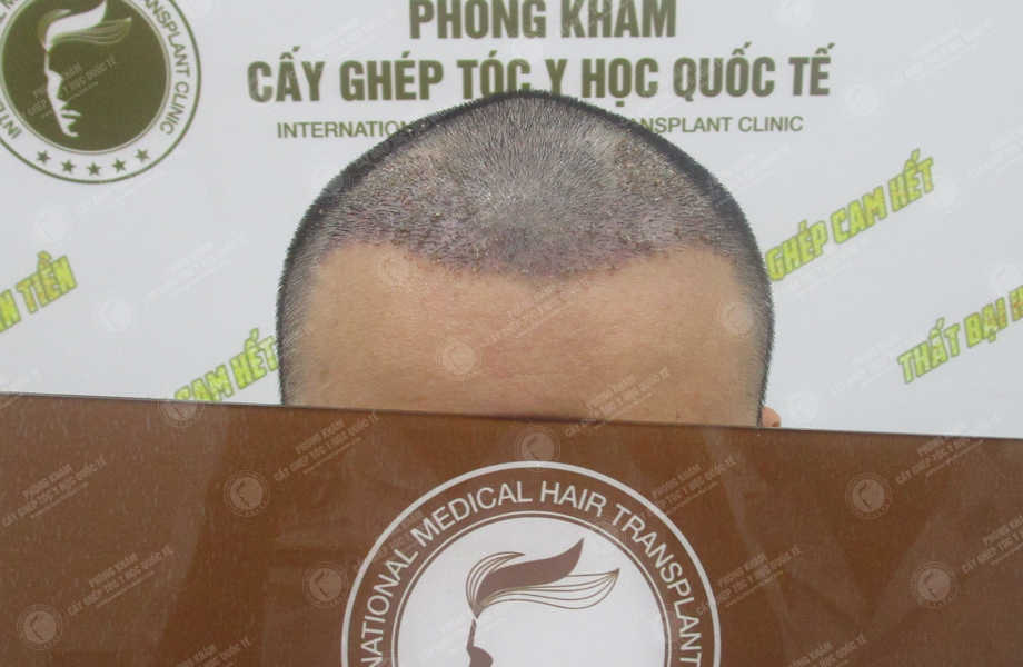 Trần Thái Sơn - Cấy tóc đường chữ M 9