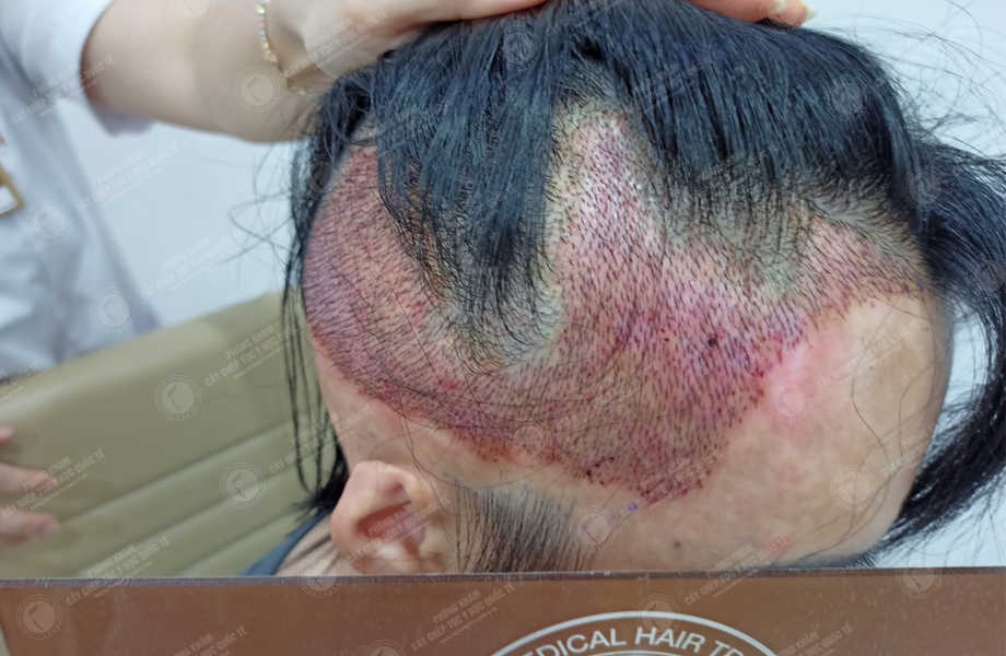 Trần Thùy Trang - Cấy tóc trên sẹo 11