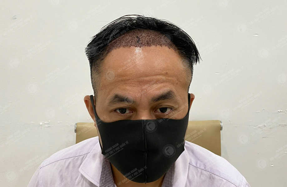 Đoàn Trọng Đức - Cấy tóc đường chữ M 6