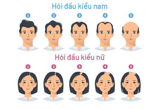 Nguyên nhân hói đầu là gì? Địa chỉ chữa hói đầu hiệu quả