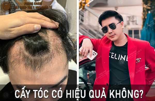 Cấy tóc tự thân có hiệu quả không? Giải đáp từ chuyên gia