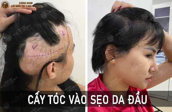 Phòng khám Cấy ghép tóc Y học Quốc Tế – Cơ sở cấy tóc trên sẹo uy tín