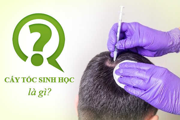 Bác sĩ chia sẻ cấy tóc sinh học là gì? Tổng quan cấy tóc sinh học