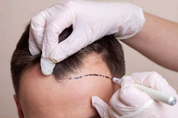 [Cập nhật]: Chi phí cấy tóc tự thân mới nhất tại TP.HCM