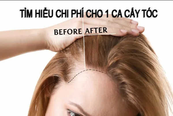 Bảng giá cấy tóc mới nhất 2024 tại các cơ sở uy tín