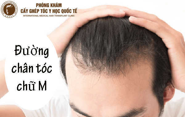 Tìm hiểu về phương pháp cấy tóc đường chữ M