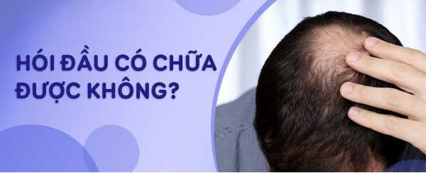 Hói đầu có chữa được không? Phương pháp chữa hói hiệu quả