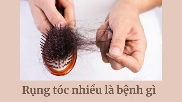 Rụng tóc nhiều là bệnh gì? Có phải do ung thư không?