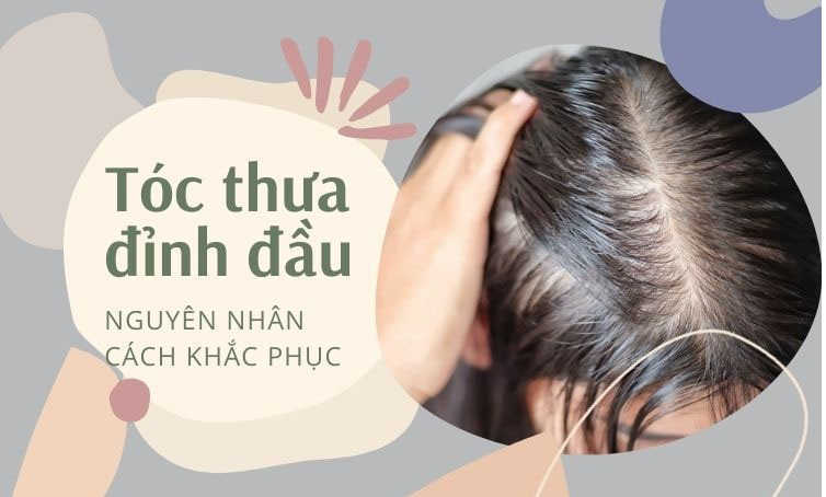 Điểm mặt 10+ nguyên nhân gây tóc thưa ở đỉnh đầu nam thường gặp