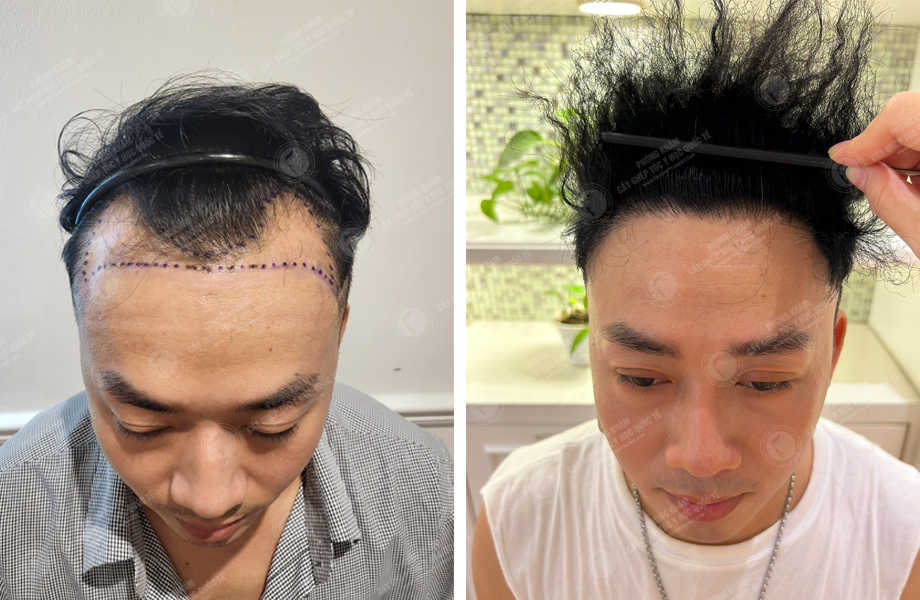 Hói đầu nam giới – Nguyên nhân và cách điều trị
