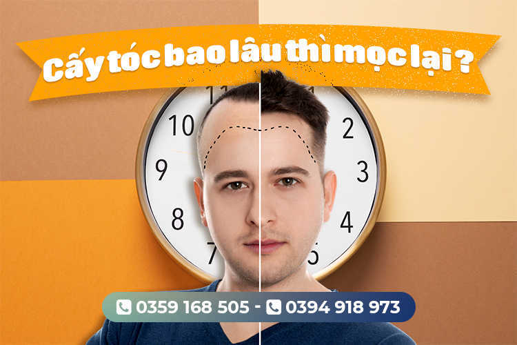 Cấy tóc bao lâu thì mọc lại – Địa chỉ cấy tóc uy tín ở TP.Hồ Chí Minh