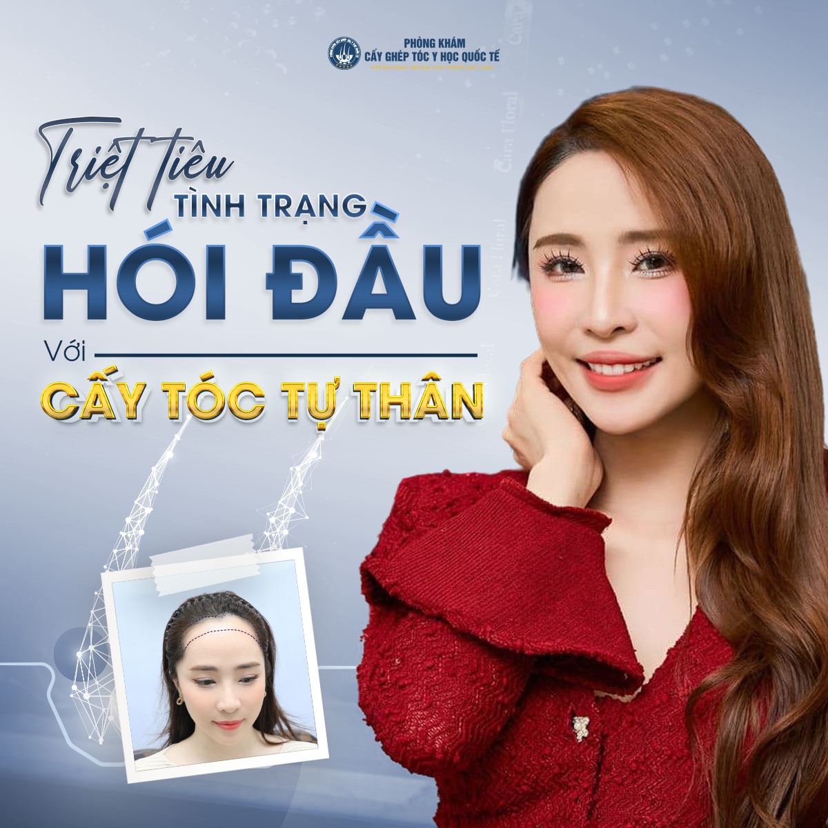 Phòng khám cấy tóc tốt nhất TpHCM đến ngay Cấy ghép tóc Y học Quốc tế